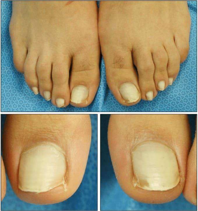 how to make toenails white at home